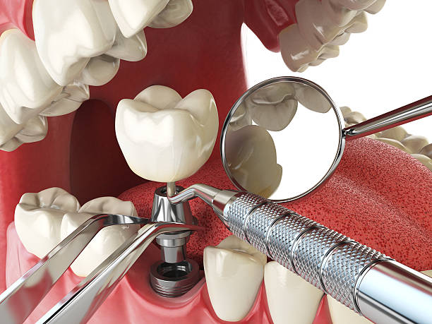 Best Emergency Dental Care for Broken or Chipped Teeth in Plains, MT